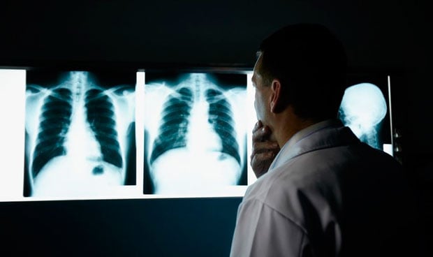 Espaa, de los pases europeos que menos invierten en cncer de pulmn