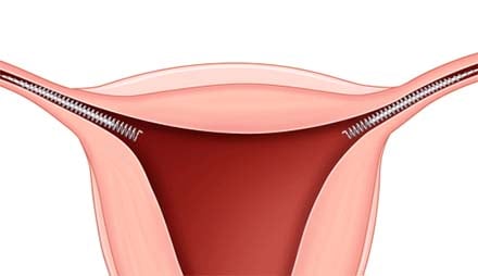 Implantación del anticonceptivo permanente en las trompas de Falopio.