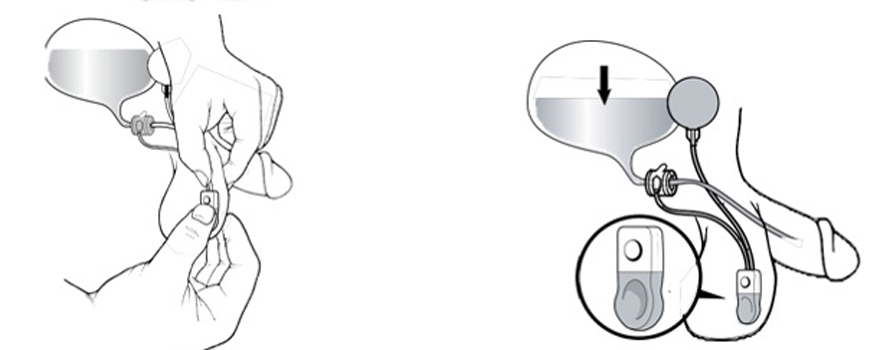 Imagen explicativa de cómo funciona el dispositivo implantado. 