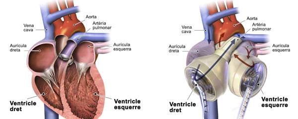 A la izquierda, corazón humano. A la derecha, corazón artificial total.