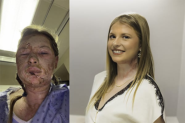 Kaitlin Jeffrey, el antes y el depsués del tratamiento.