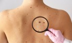 'Bloqueo' al cáncer de piel con células cutáneas humanas artificiales