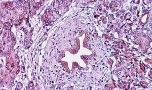 Una vacuna contra el cáncer de páncreas más inmunoterapia y anticuerpos es segura y parece eficaz.