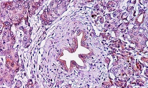 Una vacuna contra el cáncer de páncreas más inmunoterapia y anticuerpos es segura y parece eficaz.