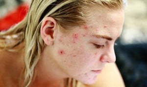 "El acné es una enfermedad, no un proceso por el que todos debamos pasar"