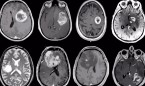 A la caza del glioblastoma: logran detectarlo con un análisis de sangre