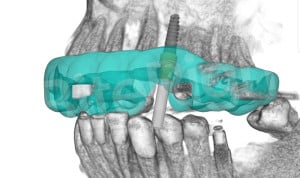 Adeslas Dental amplía su gama de prestaciones de implantología digital