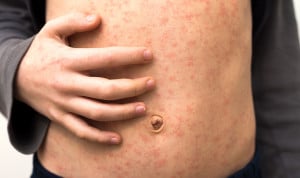 Alerta sanitaria por sarampión en España: Canarias confirma cuatro casos