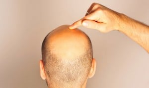 La alopecia frontal es la que más preocupa al paciente