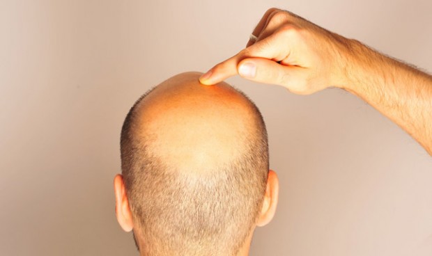 La alopecia frontal es la que más preocupa al paciente