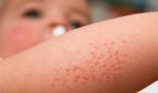 Asocian el clima con el aumento de dermatitis atópica en niños