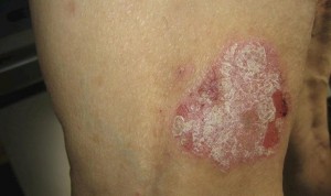 Asocian la psoriasis a un mayor riesgo de carcinomas de piel y linfomas