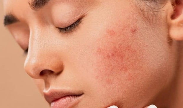 Atacar los comedones "invisibles", clave para la prevención del acné