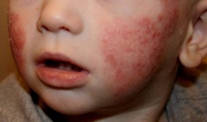 Biomarcadores de la dermatitis atópica pueden predecir el TDAH en niños