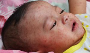 Brote de sarampión en la UE: se debe vacunar a menores de 1 año para viajar