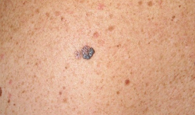 Cae la incidencia del melanoma en adolescentes y jóvenes en diez años