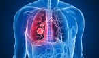 Una proteína, señalada como nueva diana para tratar el cáncer de pulmón