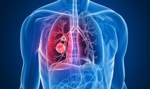 Una proteína, señalada como nueva diana para tratar el cáncer de pulmón