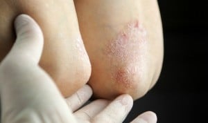 Una pomada de Cantabria Labs, el útlimo tratamiento tópico de la psoriasis