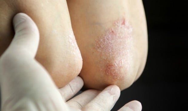 Una pomada de Cantabria Labs, el útlimo tratamiento tópico de la psoriasis