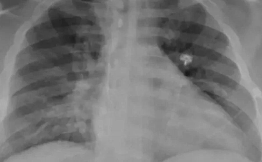 ¿Qué causas hay detrás del aumento de enfermedades respiratorias en China?