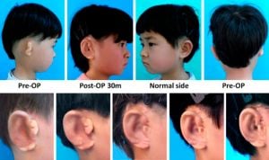 Científicos chinos implantan orejas con células cultivadas por impresión 3D