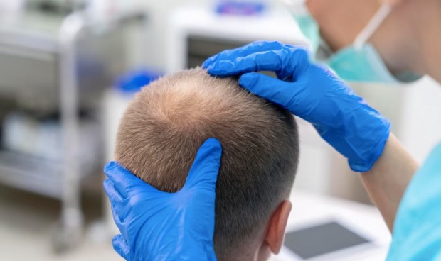 La alopecia y los peligros de someterse a una cirugía capilar en Turquía.