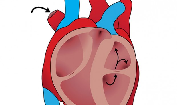 Un medicamento para la gota reduce el riesgo cardiovascular