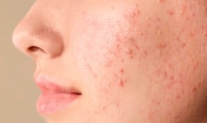 Coronavirus: 8 consejos de Dermatología sobre el acné y la isotretinoína