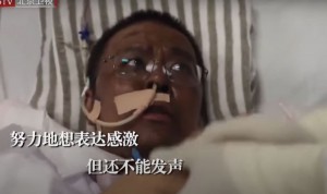 Coronavirus: médicos chinos despiertan del coma con la piel de color negro