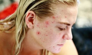 Coronavirus: recomendaciones de Dermatología para usar retinoides orales
