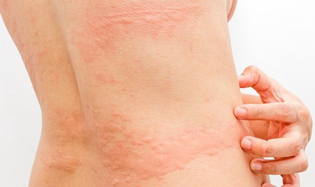 Coronavirus sntomas: efectos en la piel de hasta 150 das
