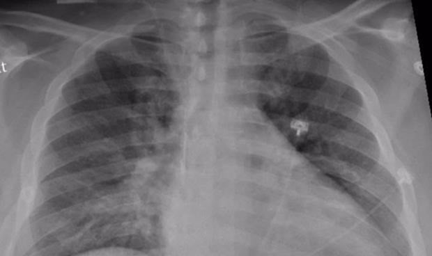 Covid: un 40% más de mortalidad en los pacientes con trasplante de pulmón