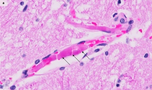 Covid: las autopsias apuntan a que entra en el cerebro a través de la nariz