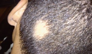 Covid-19 | Observan un aumento de la pérdida acelerada del pelo