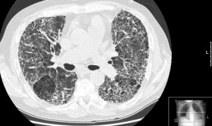 Covid: Separ avisa del retraso diagnóstico en fibrosis pulmonar idiopática