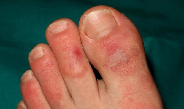 Sabañones (dedos covid) en los pies podrían ser un efecto de la respuesta inmune a COVID-19
