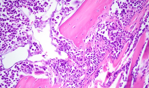 Los diagnósticos de mieloma están retrasándose por la pandemia de Covid-19