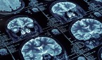Covid persistente: las secuelas neurocognitivas permanecen hasta 12 semanas
