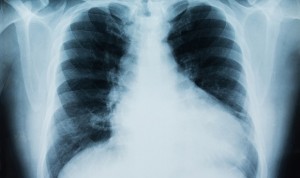 Inesperada respuesta inmune del Covid-19 en los pulmones