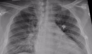 Covid-19: las 3 secuelas pulmonares tras superar la enfermedad 
