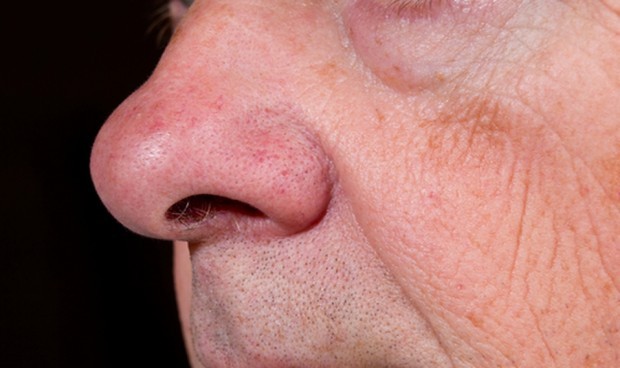 Covid: un spray nasal 'hermano' del Betadine, a prueba como tratamiento