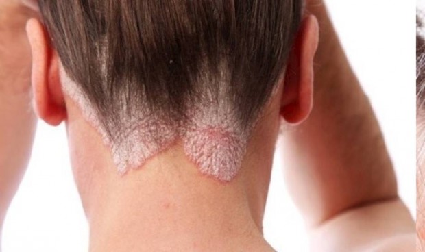 Covid: sin evidencia de que la vacuna tenga efectos negativos en psoriasis