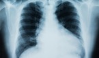 Crean una 'camisa inteligente' que controla la enfermedad pulmonar 