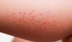 Cuatro de cada 10 pacientes de hidradenitis supurativa padecen depresión