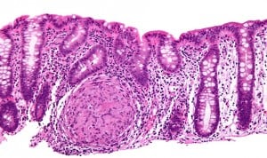 Darvadstrocel en enfermedad de Crohn: remisión combinada en el 75% de casos