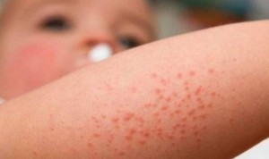La dermatitis atópica, asociada al riesgo de problemas de aprendizaje