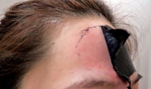 Dermatología avisa: "La mascarilla negra puede crear ampollas y cicatrices"