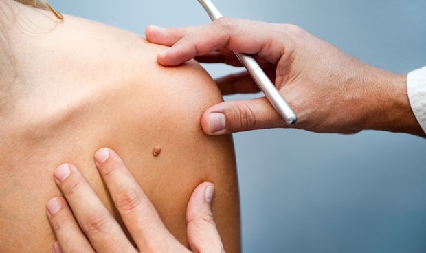 Dermatología pide más rapidez en el acceso a consultas contra el melanoma