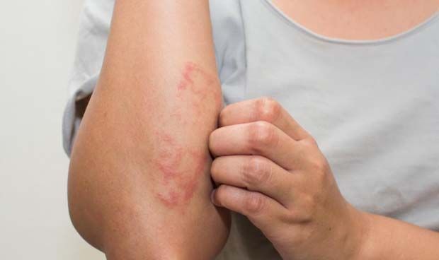 Dermatología 'pone la cruz' a Facebook e Instagram por vetar la psoriasis